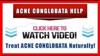 Acne Conglobata Help  Natural Treatment and Prevention [upl. by Phonsa]