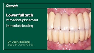 Clinical Case Lower full arch immediate placement amp loading [upl. by Otrepur]