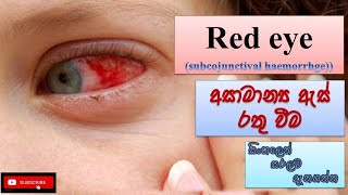 Red eye අසාමාන්‍ය ඇස් රතු වීම් how it happens causes symptoms treatment how to prevent [upl. by Eijneb]