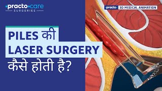 Piles Laser Surgery  Procedure Animation  Best Treatment for Piles  Practo Care Surgeries [upl. by Myrwyn]