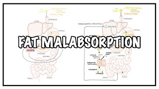 Approach to Fat malabsorption  signs and symptoms and causes [upl. by Swayder612]