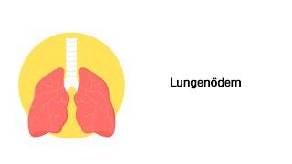 Lungenödem  Erkrankungen der Atemwege [upl. by Nilram971]