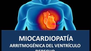 Miocardiopatía arritmogénica [upl. by Haldeman]