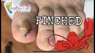 Painful Pinched Toe Nail [upl. by Malvie]