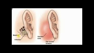 Biodescodificación  Mastoiditis [upl. by Atinahc]