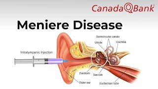 Meniere Disease [upl. by Carling]