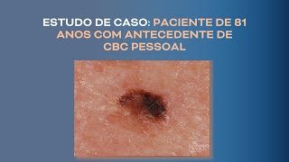 NEVO COMPOSTO BENIGNO ou MELANOMA em paciente de 81 anos 0 Dermatoscopia  Lesão origem melanocítica [upl. by Sedgewinn]