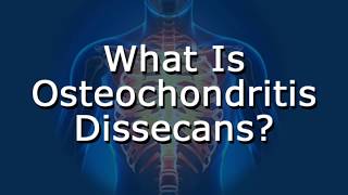 What Is Osteochondritis Dissecans [upl. by Poirer795]