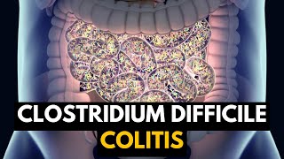 CLOSTRIDIUM DIFFICILE COLITIS Causes Signs and Symptoms Diagnosis and Treatment [upl. by Ariet]