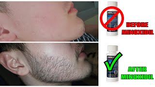 5 BIGGEST MISTAKES When Using Minoxidil REVEALED [upl. by Kabob203]