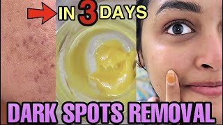 Remove Pimples and Acne Scars by Homemade Face Pack  Dark Spots  Dr Manthenas Beauty Tips [upl. by Konstanze]