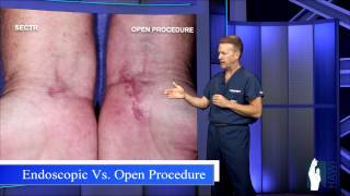 Carpal Tunnel Release  Open Procedure vs Endoscopic [upl. by Tri]