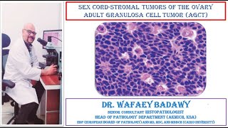 SEX CORD STROMAL TUMORS OF THE OVARY ADULT GRANULOSA CELL TUMOR BY DR WAFAEY BADAWY [upl. by Lauer]