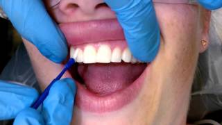 Tips For Applying Fluoride Varnish [upl. by Mattox901]