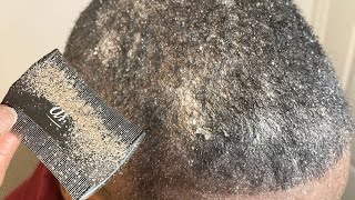 Close up Scalp Cleanse ASMR We Scratch You Relax [upl. by Kellia427]