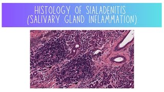 Histology of Sialadenitis Salivary Gland Inflammation [upl. by Iatnohs]