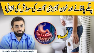 Ulcerative Colitis  Treatment And Symptoms  Bari Anth Ki Sozish [upl. by Lindsey]