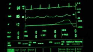 intensive care sleep EKG and SpO2 monitoring [upl. by Alleynad617]