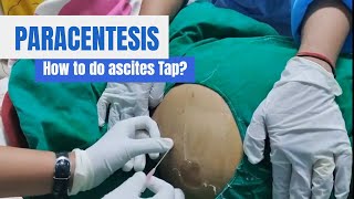 Paracentesis Procedure Ascites Tap in detail [upl. by Ardnosal]