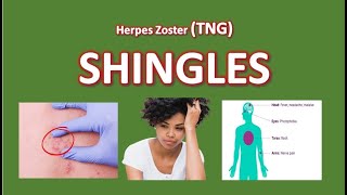 Shingles Management Risk Factor Infection and Treatments [upl. by Ecnatsnoc]