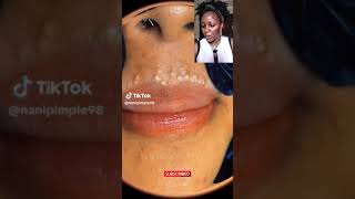 An Acne Sufferer REACTS to VIRAL TIKTOK PIMPLE POPPING VIDEO lip acne  Blackhead Extraction [upl. by Shamma626]