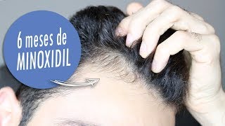 MINOXIDIL DEPOIS 6 MESES [upl. by Noraha698]