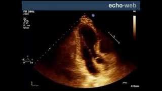 Introduction to Cardiac Ultrasound [upl. by Eelsew422]