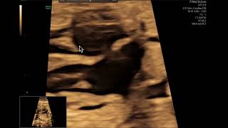 Ecocardiografía fetal Como evaluar el tabique interauricular [upl. by Matta]