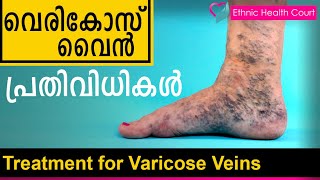 Treatment for Varicose Veins  വെരികോസ് വൈൻ പ്രതിവിധികൾ   Ethnic Health Court [upl. by Fritz]