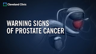 10 Warning Signs of Prostate Cancer [upl. by Ecydnac]