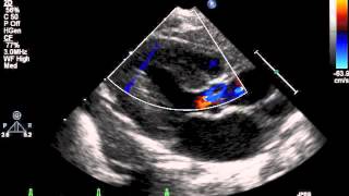 How to do pediatric echocardiography study [upl. by Campy]