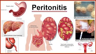 peritonitis [upl. by Atiraj]