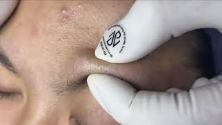 Relax EveryDay With Nhat Bang Spa 2024 Blackheads Removal On Teen [upl. by Weixel]