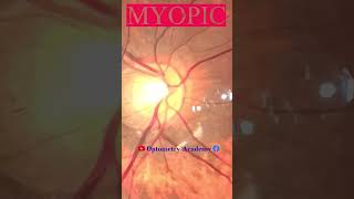 Myopic Fundus  Fundus Photography  Myopic Crescent  Short Video 158 viral optometryacademy [upl. by Ardnait]