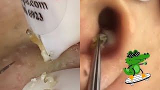 Ultimate ASMR Pimple Popping Compilation  Blackhead amp Cyst Extraction for Maximum Relaxation [upl. by Mosa]