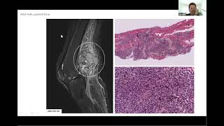 Molecular characterization of mesenchymal tumors promises and challenges [upl. by Yknarf]