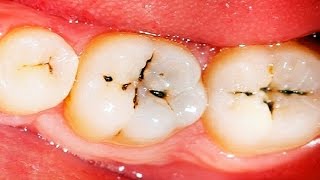 How to Get Rid of Cavities  How to Reverse Cavities in Teeth [upl. by Gaye]