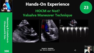 HandsOn Experience 23 HOCM or Not Valsalva Maneuver Technique [upl. by Nauh276]