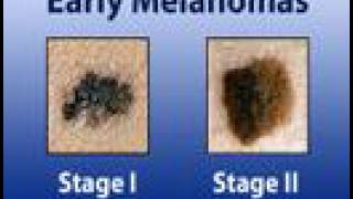 Treating Melanoma Skin Cancer 8 [upl. by Kielty]