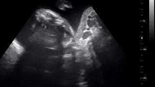 interesting case 467 ultrasound 2D 3D 4D acardiac twin [upl. by Atiek]