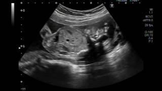 Ultrasound Video showing Anencephaly [upl. by Aeht]