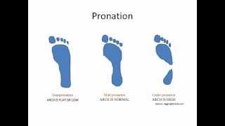 What Is Overpronation [upl. by Corella]