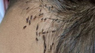 Head Lice Cleared Out From Hair At Home nimelice [upl. by Kirbee121]