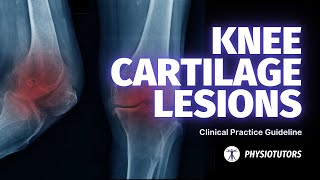 Knee Cartilage Lesions  Physiotherapy Guideline [upl. by Nonna]