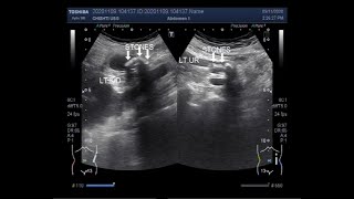 Ultrasound Video showing Pyonephrosis with multiple renal and ureteric stones [upl. by Shurlocke]