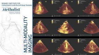 Echo Assessment of Hemodynamics and Echo Assessment of LV Function M Quinones MD amp S Nagueh MD [upl. by Sitnalta]