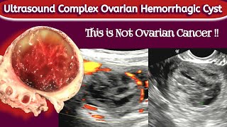 Ovarian Cyst with BLEED  TVS Ultrasound  Hemorrhagic Cyst [upl. by Aleirbag]