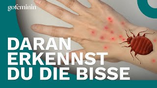 Bettwanzen Daran erkennst du die Bisse [upl. by Leahcimnoj753]