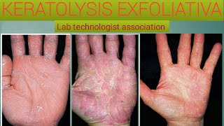 Everything you know about keratolysis exfoliativa [upl. by Ahsitaf473]