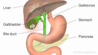 Gallbladder Removal Surgery Animation [upl. by Arbba540]